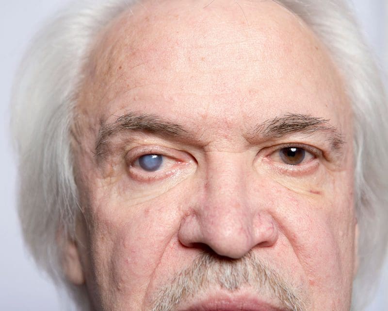 Eye Diseases & Disorders Collins Eye Center